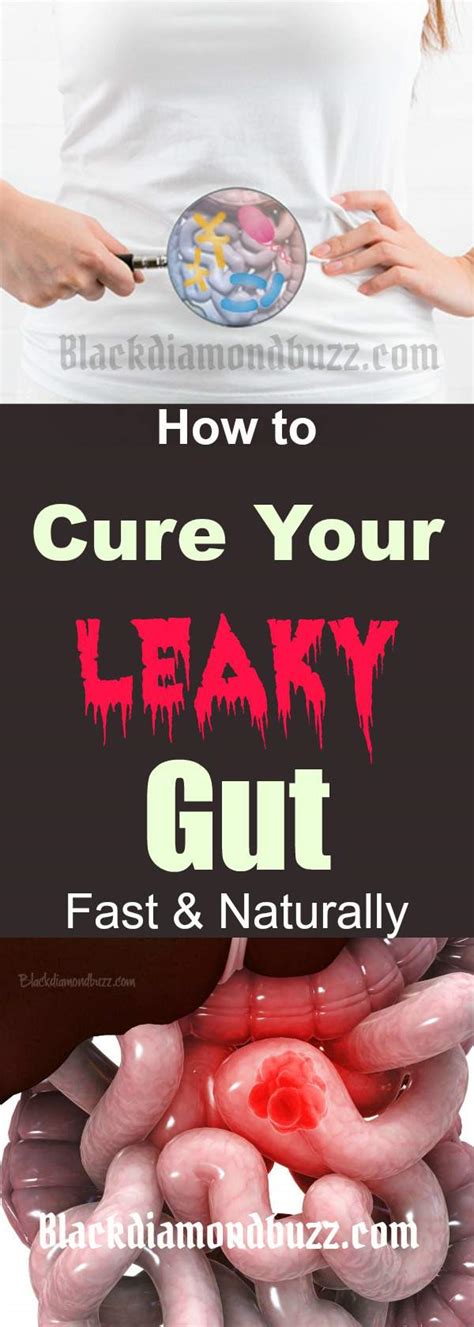 If the leakage is minor, symptoms will generally be confined to the gastrointestinal (gi) tract, explains tom sult, md. How to Heal Leaky Gut Naturally - Leaky Gut Cure Diet ...