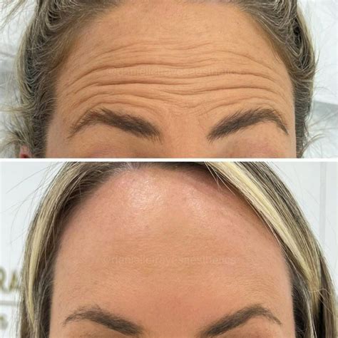 Anti Wrinkle Injections And Dermal Fillers Rejuvenate Laser And Skin Clinic