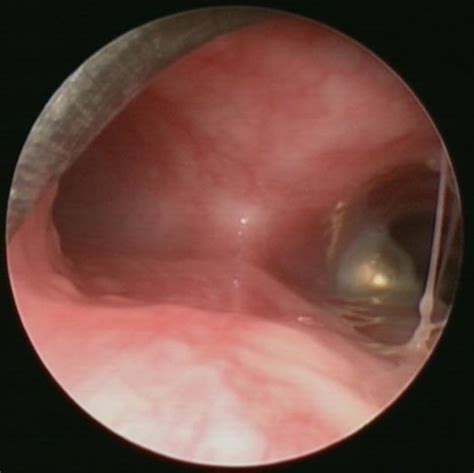 Endoscopic Management Of Pediatric Airway And Esophageal Foreign Bodies