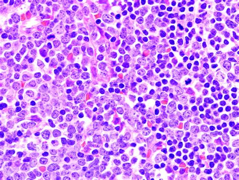 Precursor B Cell Acute Lymphoblastic Leukemia