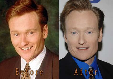 Conan Obrien Plastic Surgery Top Celebrity Surgery