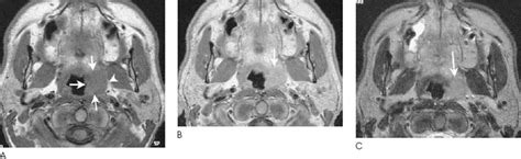 Squamous Cell Carcinoma Of The Palatine Faucial Tonsil Radiology Key