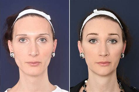 Brow Lift Feminizing The Eyebrows 2pass Clinic