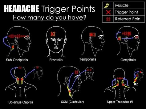 Headache Trigger Points Massage Therapy Trigger Points Trigger