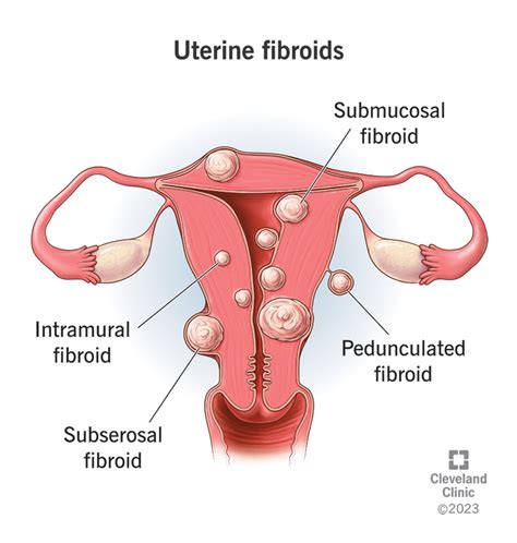 Understanding Fibroids Causes Symptoms And Treatments Ask The Nurse Expert