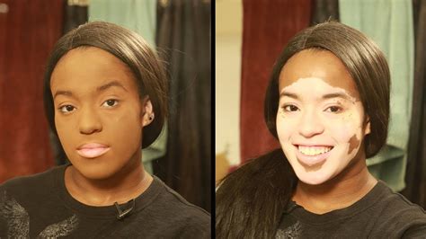 Terbaru 32 Vitiligo Makeup