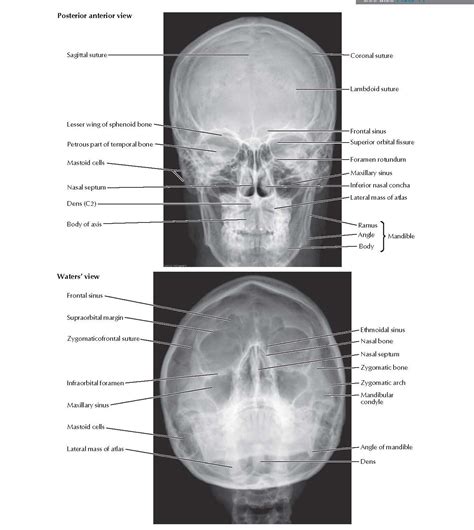 Skull Radiographs Anatomy Pediagenosis