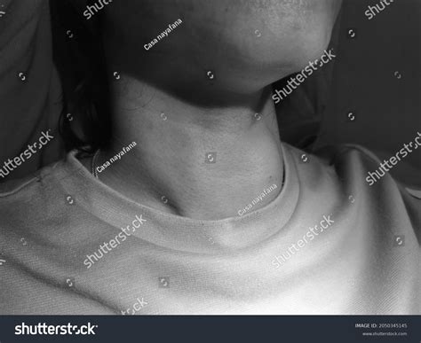 Anterior Neck Swelling Known Goitre Vecause Stock Photo 2050345145