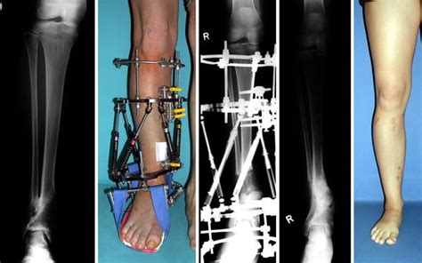 Accuracy Of Complex Lower Limb Deformity Correction With External