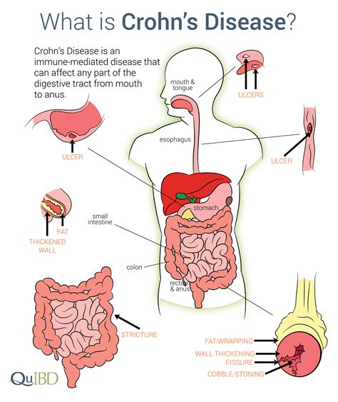 Crohns Disease Ibd Symptoms Advances Impact Causes