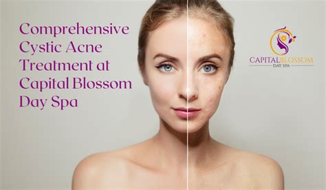 Comprehensive Cystic Acne Treatment At Capital Blossom Day Spa