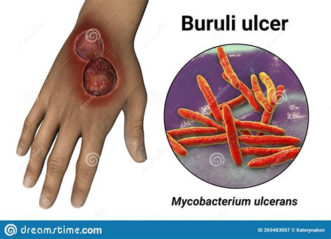 Buruli Ulcer On An Arm 3d Illustration The Disease Caused By
