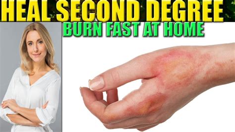 How To Heal A Burn Fast 2nd Degree Burns Wound Care Home Remedies