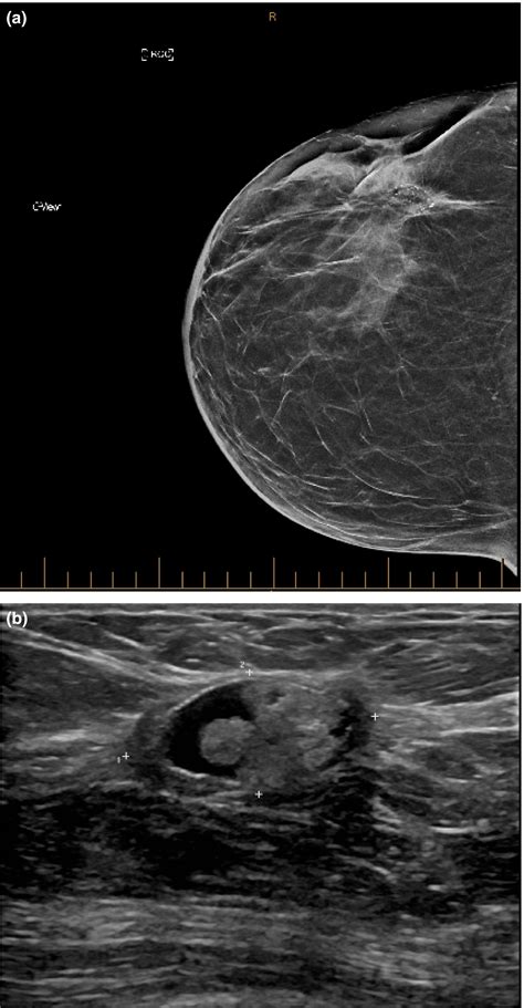 Sonographic Features Of Inflammatory Conditions Of The Breast Febery