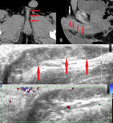Penile Mondor S Disease Imaging In Two Cases Foresti Journal Of Radiology Case Reports