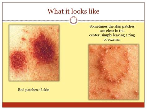 Discoid Eczema Pictures Photos