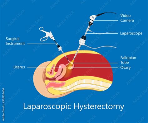 Laparoscopic Hysterectomy Medical Surgical Treat Cervix Ovary Subtotal