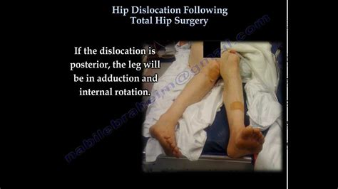 Hip dislocation, congenital / diagnosis*. Hip Dislocation Following Total Hip replacement ...