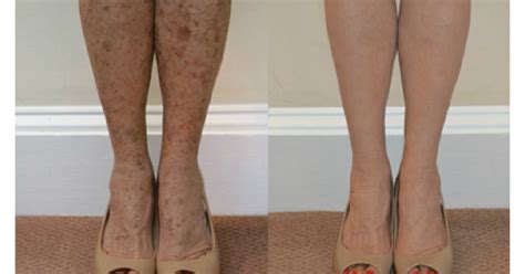 Anti Aging And Skin Correction Blog Im Fabulous Tca Body Peel