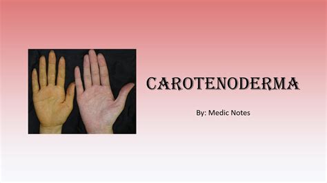 Carotenoderma Orange Skin Causes And Pathophysiology Youtube