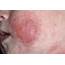 Infected Eczema  Stock Image M150/0264 Science Photo Library