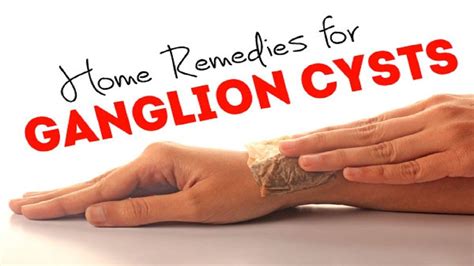 How To Get Rid Of Ganglion Cyst On Knuckle Curtis Jones Kapsels