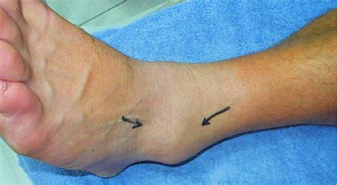 Management And Prevention Of Acute And Chronic Lateral Ankle