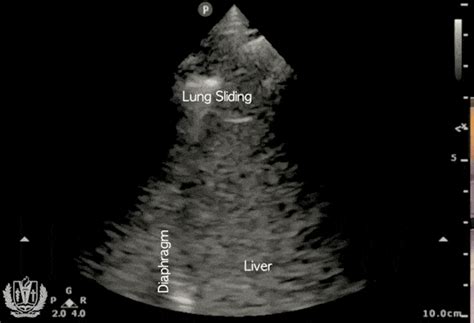 Lung Ultrasound Made Easy Step By Step Guide Pocus 101 Point Of