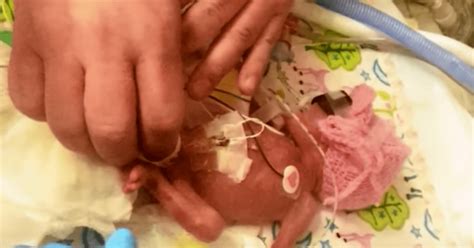 Baby Born At Weeks Had Feet The Size Of Pennies And Now This Babe Miracle Is Proving