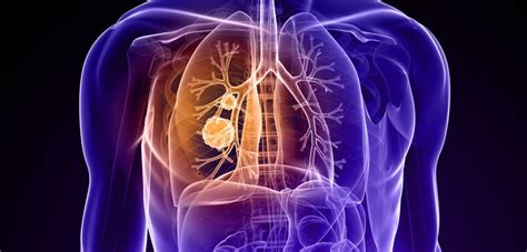Lungenkrebs Fakten Zum Krebs In Der Lunge