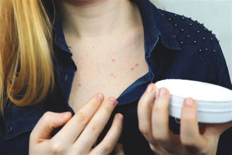 Chest Acne Causes And Treatments And How It Differs From Facial Acne