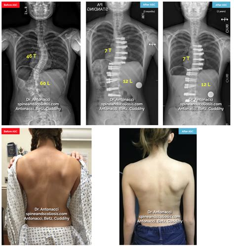 Before After Spinal Fusion Surgery For Scoliosis Pics My Xxx Hot Girl