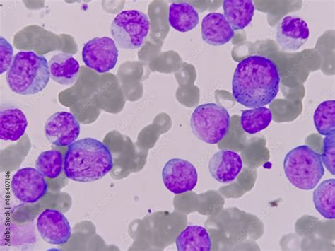 Blood Cancer Leukemia Awareness Photomicrograph Of Bone Marrow