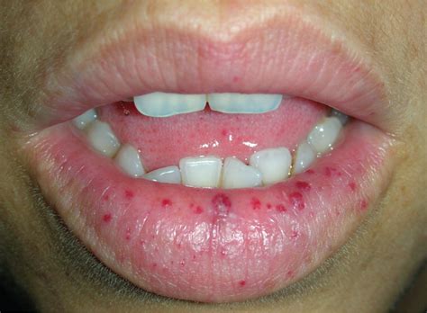 Anemia Lips