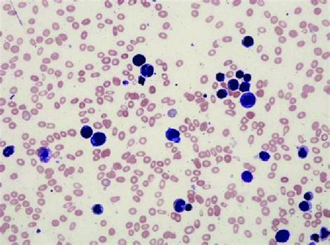 Peripheral Smear Normocytic Normochromic Anemia With Ovalocytes And An