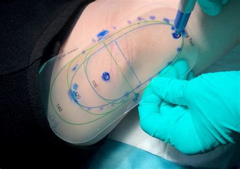 The Hyperhidrosis Treatment Plastic Surgeons Are Loving