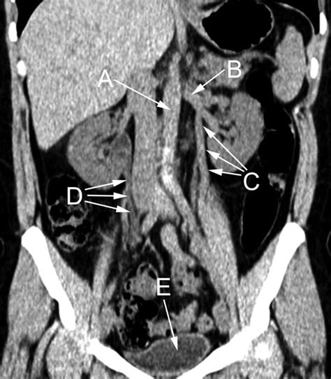 Coronal Image Of Non Contrast Abdominal Computed Tomography The Bmj