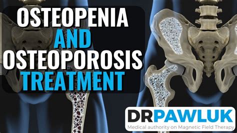 Osteopenia And Osteoporosis Treatment With Pemfs Electromagnetic