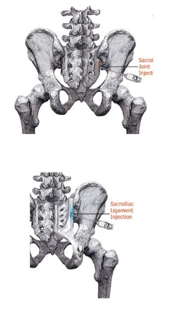 Sacroiliac Joint Injection For Low Back And Buttock Pain Point Performance Images And Photos