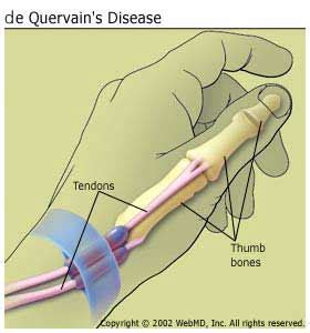 Doctors usually diagnose de quervain's tenosynovitis easily through a physical examination. de Quervain's Tenosynovitis: Symptoms, Causes, Diagnosis ...