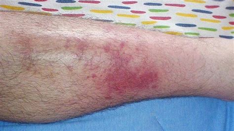 Cellulitis Everything You Need To Know