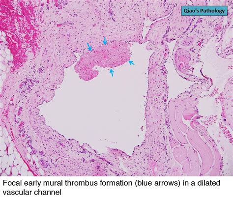 Pathology Outlines Venous Hemangioma