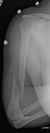 Read about how to diagnose and treat the radial nerve runs posteriorly around the middle third of the humeral shaft in the spiral groove. Shoulder and Elbow Surgery: Distal spiral metaphyseal humerus fractures - The working length of ...