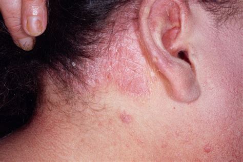 Seborrheic Dermatitis Psoriasis Hairline Javsystema