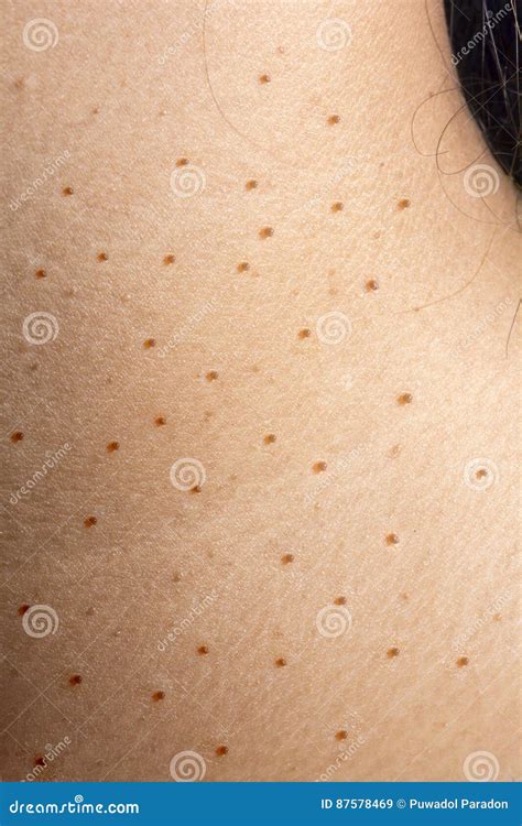 Wart Or Dermatitis On Neck Skin Stock Image Image Of Wart Senior