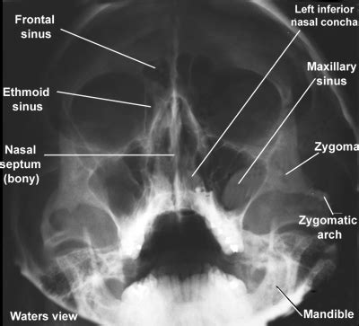 Learn about how they function and support other parts of your body. X-ray of facial structures, Waters view: I remember those ...