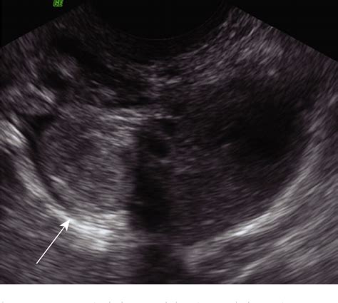 Figure 2 From The Role Of Ultrasonography In The Diagnosis And