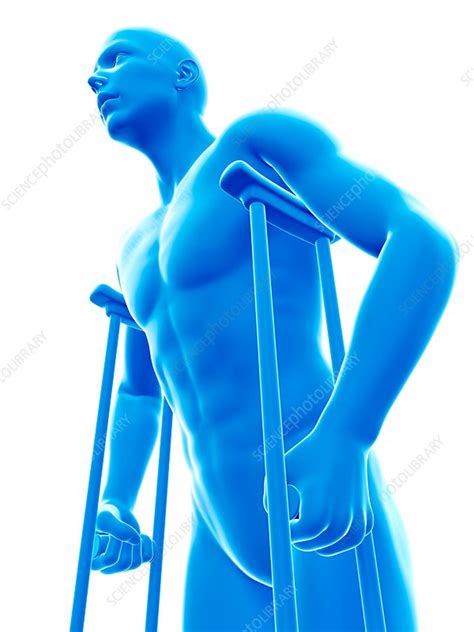 Man On Crutches Illustration Stock Image F0207994 Science Photo