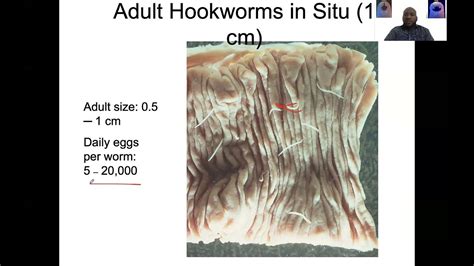 Hookworm Lem Lecture Youtube