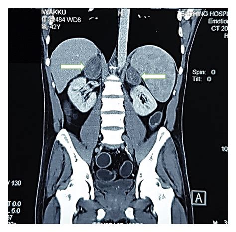 Cect Abdomen Showing Bilateral Adrenal Masses White Arrows